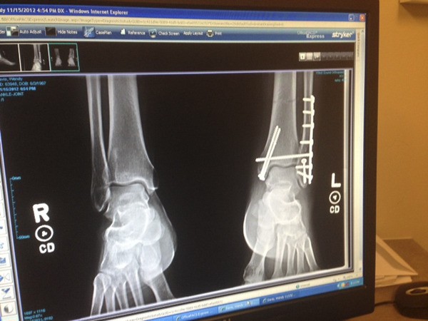 Poulsbo sergeant Wendy Davis' X-rays after her ankle surgery. Davis fractured her ankle and foot from a 'dangerous' obstacle during the Extreme K Mud Run Oct. 6.